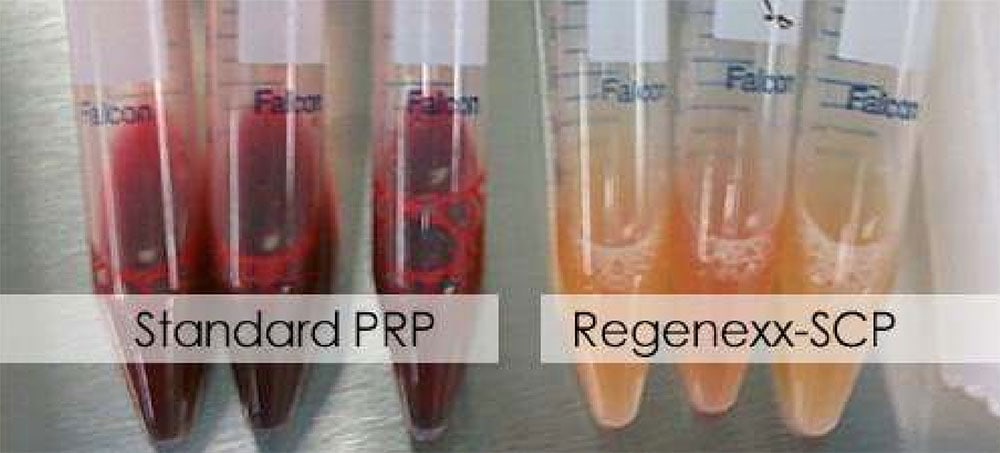 platelet rich plasma prp